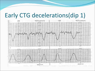 Early CTG decelerations(dip 1) 