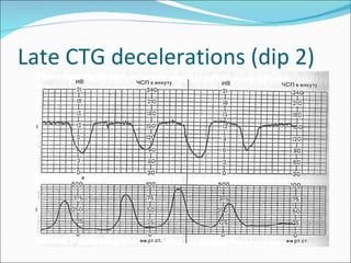Late CTG decelerations (dip 2) 