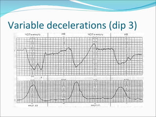 Variable decelerations (dip 3) 
