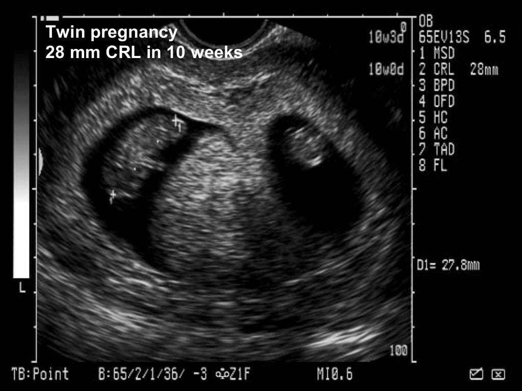 Obstetric ultrasound