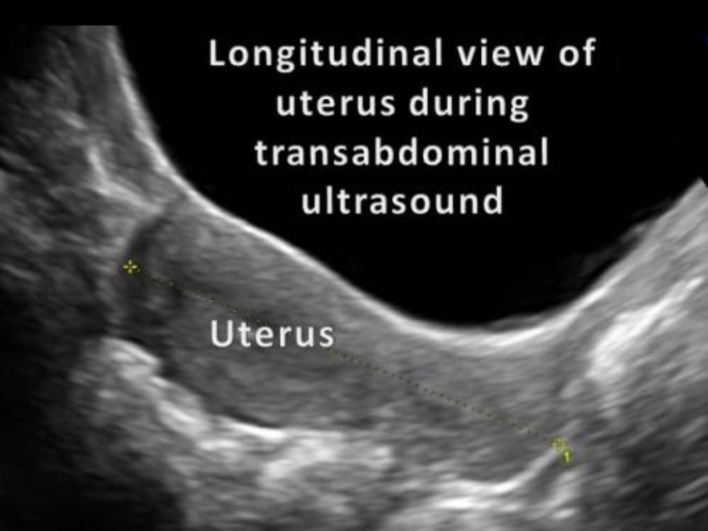 Obstetric ultrasound