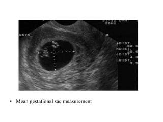 Gs Measure Obstetric ultrasound - Radiology | PPTX