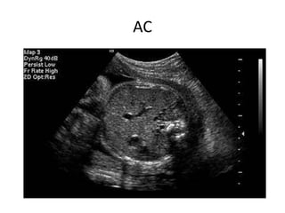 Obstetric ultrasound - Radiology | PPTX