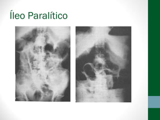 Íleo Paralítico
 
