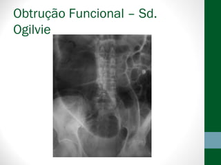 Obtrução Funcional – Sd.
Ogilvie
 