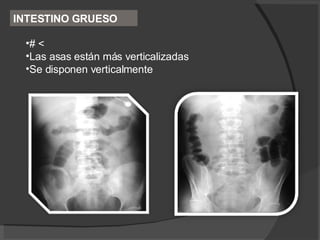 INTESTINO GRUESO # < Las asas están más verticalizadas Se disponen verticalmente 