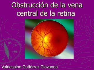Obstrucción de la vena central de la retina  Valdespino Gutiérrez Giovanna  