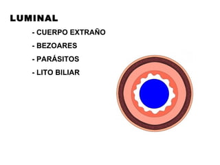 LUMINAL - CUERPO EXTRAÑO - BEZOARES - PARÁSITOS - LITO BILIAR