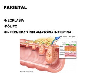 PARIETAL NEOPLASIA PÓLIPO ENFERMEDAD INFLAMATORIA INTESTINAL