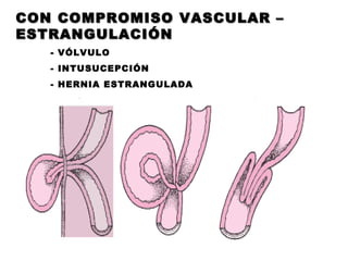CON COMPROMISO VASCULAR – ESTRANGULACIÓN - VÓLVULO - INTUSUCEPCIÓN - HERNIA ESTRANGULADA