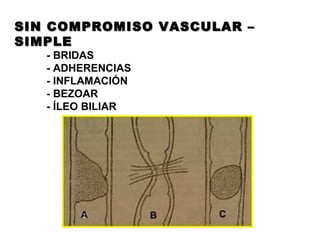 SIN COMPROMISO VASCULAR – SIMPLE - BRIDAS - ADHERENCIAS - INFLAMACIÓN - BEZOAR - ÍLEO BILIAR