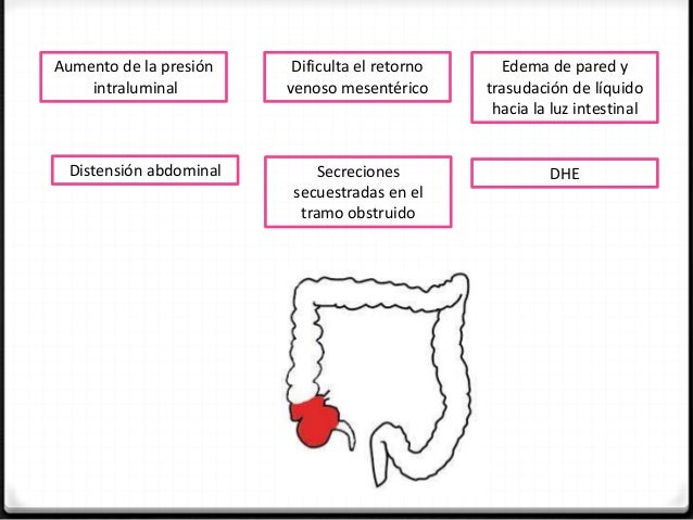 Obstrucción intestinal