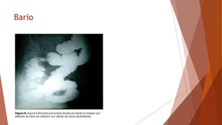 Bario
 