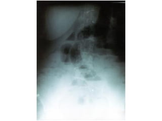 Obstrucción intestinal