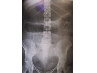 Obstrucción intestinal