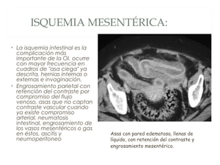 ISQUEMIA MESENTÉRICA:
• La isquemia intestinal es la
complicación más
importante de la OI, ocurre
con mayor frecuencia en
cuadros de "asa ciega" ya
descrita, hernias internas o
externas e invaginación.
• Engrosamiento parietal con
retención del contraste por
compromiso del flujo
venoso, asas que no captan
contraste vascular cuando
ya existe compromiso
arterial, neumatosis
intestinal, engrosamiento de
los vasos mesentéricos o gas
en éstos, ascitis y
neumoperitoneo
Asas con pared edematosa, llenas de
líquido, con retención del contraste y
engrosamiento mesentérico.
 