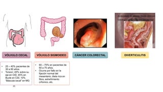 23
VÓLVULO CECAL VÓLVULO SIGMOIDEO CÁNCER COLORECTAL DIVERTICULITIS
• 25 – 40% pacientes de
30 a 60 años.
• Torsion: 45% sobre su
eje en CID, 45% en
Bucle en CSI, 10%
“Báscula cecal” en MG
• 60 – 75% en pacientes de
60 a 70 años.
• Ocurre por fallo en la
fijación normal del
mesenterio, dieta rica en
fibra, estreñimiento
crñonico, etc.
 