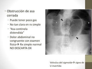 • Obstrucción de asa
cerrada
• Puede tener poco gas
• No tan clara en rx simple
• “Asa centinela
distendida”
• Dolor abdominal no
congruente con examen
físico Rx simple normal
NO DESCARTA DX
Volvulus del sigmoide signo de
U invertida
 