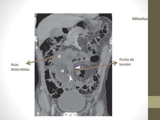 Vólvulus
Asas
distendidas
Punto de
torsión
 