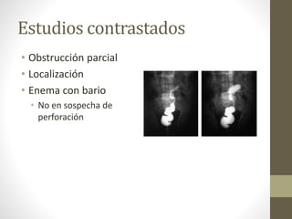 Estudios contrastados
• Obstrucción parcial
• Localización
• Enema con bario
• No en sospecha de
perforación
 