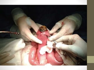 Íleo biliar
• Erasmus Bartolim en
1654
• 1-4% de obstrucciones
mecánicas
• Sospechar en:
• Cólico biliar recurrente.
• Historia de colelitiasis
• Fistula entre árbol
biliar e intestino.
• >2,5 cm
• Triada de mordor
• Historia de colelitiasis,
signos clinicos de
colecisitis y obstrucción
intestinal
• Localización
• Ileon 60.5%
• Yeyuno 16.1%
• Estomago 14.2%
• Colon 4.1%
• Duodeno 3.5%
 