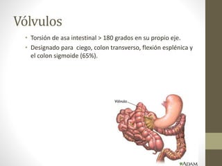 Vólvulos
• Torsión de asa intestinal > 180 grados en su propio eje.
• Designado para ciego, colon transverso, flexión esplénica y
el colon sigmoide (65%).
 