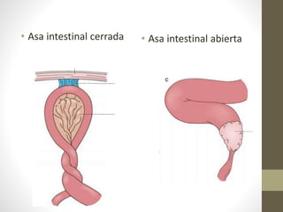 • Asa intestinal cerrada • Asa intestinal abierta
 