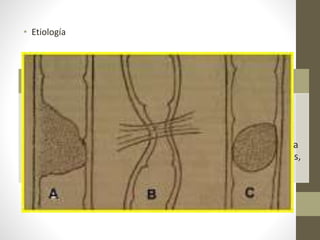 • Etiología
Intraluminal
• Intusucepción
• Parásitos
• Cuerpo extraño
• Cálculos
Intramural
• Diverticulitis
• Enf. Chron
• Neoplasias del
colon
• Hematoma
intramural
Extrínseco
• Adhesiones
• Hernias
• Volvulus
• Efecto de masa
(endometriosis,
abscesos)
 