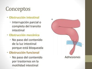 Obstrucción intestinal