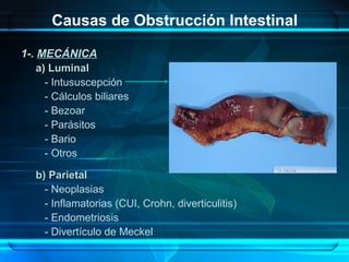 Causas de Obstrucción Intestinal
1-. MECÁNICA
a) Luminala) Luminal
- Intususcepción
- Cálculos biliares
- Bezoar
- Parásit...