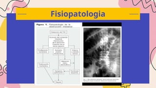 Patho Intestinal Obstruction Comprehensive Overview of Intestinal Obstruction: Anatomy ...