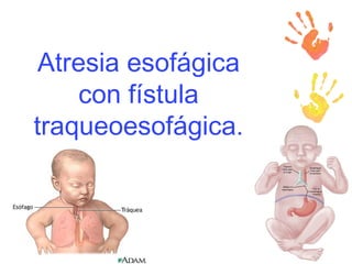 Atresia esofágica con fístula traqueoesofágica. 