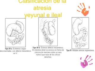 Clasificación de la atresia  yeyunal e ileal 