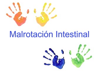   Malrotación Intestinal 