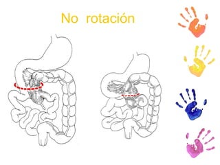No  rotación 