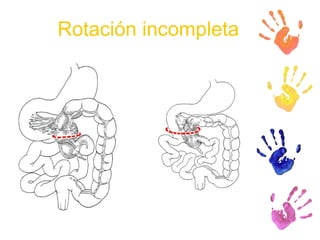 Rotación incompleta 