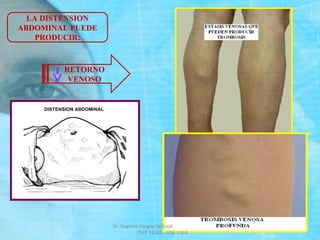 RETORNO
VENOSO
LA DISTENSION
ABDOMINAL PUEDE
PRODUCIR:
Dr. Eugenio Vargas Carbajal
CMP 11161 - RNE 4368
 