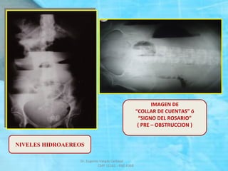 IMAGEN DE
“COLLAR DE CUENTAS” ó
“SIGNO DEL ROSARIO”
( PRE – OBSTRUCCION )
NIVELES HIDROAEREOS
Dr. Eugenio Vargas Carbajal
CMP 11161 - RNE 4368
 
