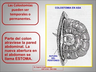 Dr. Eugenio Vargas Carbajal                            
     CMP 11161 - RNE 4368
Las Colostomías 
pueden ser 
temporales o 
permanentes.
Parte del colon
atraviese la pared
abdominal. La
nueva abertura en
el abdomen se
llama ESTOMA.
 