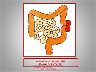 Dr. Eugenio Vargas Carbajal
CMP 11161 - RNE 4368
COLOSTOMÍA TIPO MIKULITZ
(CAÑON DE ESCOPETA)
 