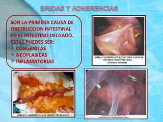 SON LA PRIMERA CAUSA DE
OBSTRUCCION INTESTINAL
EN EL INTESTINO DELGADO.
ESTAS PUEDES SER:
 CONGENITAS
 NEOPLASICAS
 INFLAMATORIAS
Dr. Eugenio Vargas Carbajal
CMP 11161 - RNE 4368
 