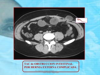 TAC de OBSTRUCCION INTESTINAL
POR HERNIA EXTERNA COMPLICADA
Dr. Eugenio Vargas Carbajal
CMP 11161 - RNE 4368
 