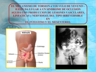 EL MECANISMO DE TORSION ó VOLVULO DE YEYUNO –
ILEON DA LUGAR A UN SINDROME DE OCLUSION
AGUDA CON PRODUCCION DE LESIONES VASCULARES,
LINFATICAS y NERVIOSAS; DEL TIPO IRREVERSIBLE
EN
EL INTESTINO Y EL MESENTERIO.
Dr. Eugenio Vargas Carbajal
CMP 11161 - RNE 4368
 