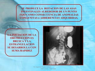 SE PRODUCE LA ROTACION DE LAS ASAS
INTESTINALES ALREDEDOR DE UN PUNTO
FIJO COMO CONSECUENCIA DE ANOMALIAS
CONGENITAS ó ADHERENCIAS ADQUIRIDAS.
LA INICIACION DE LA
OBSTRUCCION ES
BRUSCA Y LA
ESTRANGULACION
SE DESARROLLA CON
SUMA RAPIDEZ
Dr. Eugenio Vargas Carbajal
CMP 11161 - RNE 4368
 