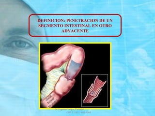 DEFINICION: PENETRACION DE UN
SEGMENTO INTESTINAL EN OTRO
ADYACENTE
Dr. Eugenio Vargas Carbajal
CMP 11161 - RNE 4368
 
