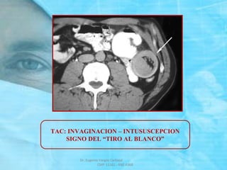 TAC: INVAGINACION – INTUSUSCEPCION
SIGNO DEL “TIRO AL BLANCO”
Dr. Eugenio Vargas Carbajal
CMP 11161 - RNE 4368
 