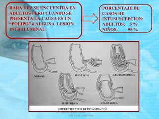 RARA VEZ SE ENCUENTRA EN
ADULTOS PERO CUANDO SE
PRESENTA LA CAUSA ES UN
“POLIPO” ó ALGUNA LESION
INTRALUMINAL
PORCENTAJE DE
CASOS DE
INTUSUSCEPCION:
ADULTOS: 5 %
NIÑOS: 95 %
Dr. Eugenio Vargas Carbajal
CMP 11161 - RNE 4368
 