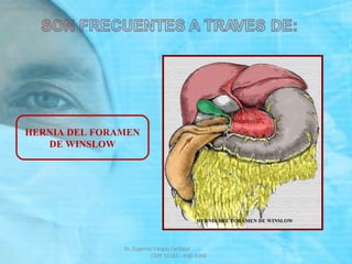 HERNIA DEL FORAMEN
DE WINSLOW
Dr. Eugenio Vargas Carbajal
CMP 11161 - RNE 4368
 