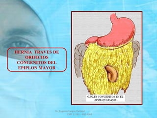 HERNIA TRAVES DE
ORIFICIOS
CONGENITOS DEL
EPIPLON MAYOR
Dr. Eugenio Vargas Carbajal
CMP 11161 - RNE 4368
 