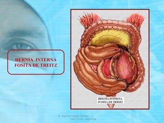HERNIA INTERNA
FOSITA DE TREITZ
Dr. Eugenio Vargas Carbajal
CMP 11161 - RNE 4368
 